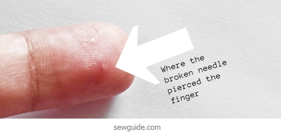finger pierced with a broken needle - choosing the right needle is important